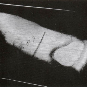 壓鑄件中波紋狀和湖狀痕跡的產(chǎn)生原因及解決方案